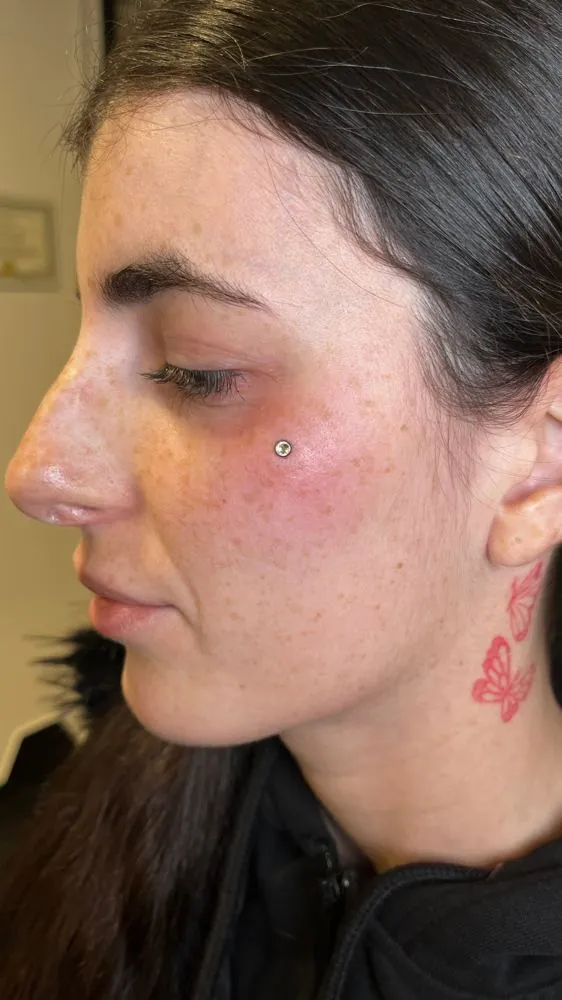 Piercing dermal en la mejilla con joya de titanio